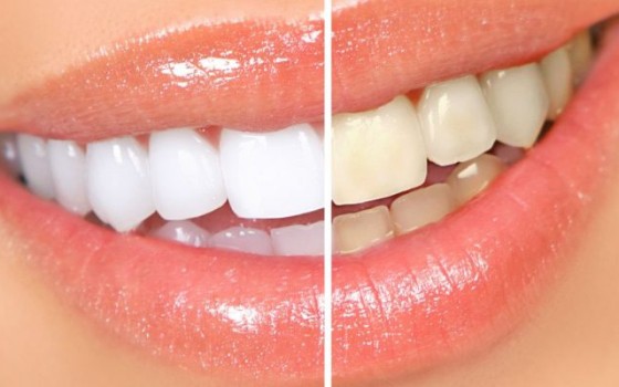 izbeljivanje zuba novi sad