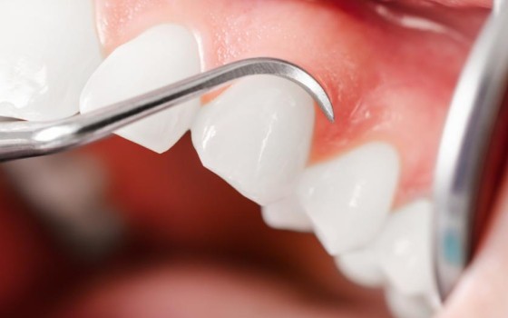 Skidanje kamenca sa zuba i poliranje