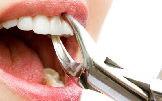 Bezbolno vađenje zuba i zaostalih korenova